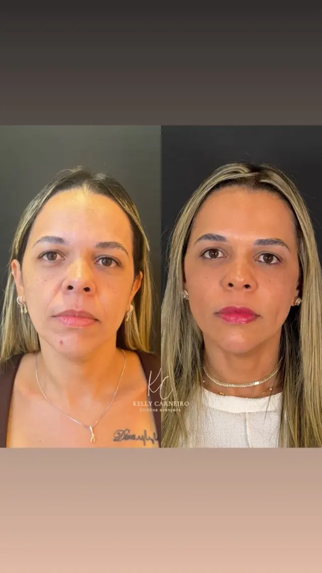 Antes e depois de procedimento de harmonização facial em Contagem, paciente 2