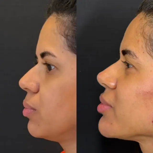 Antes e depois de procedimento de harmonização facial em Contagem, paciente 3