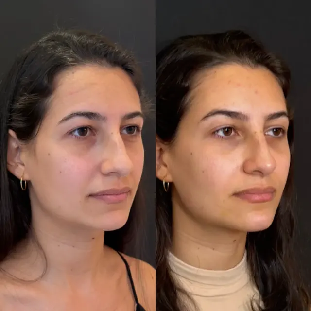 Antes e depois de procedimento de harmonização facial em Contagem, paciente 5