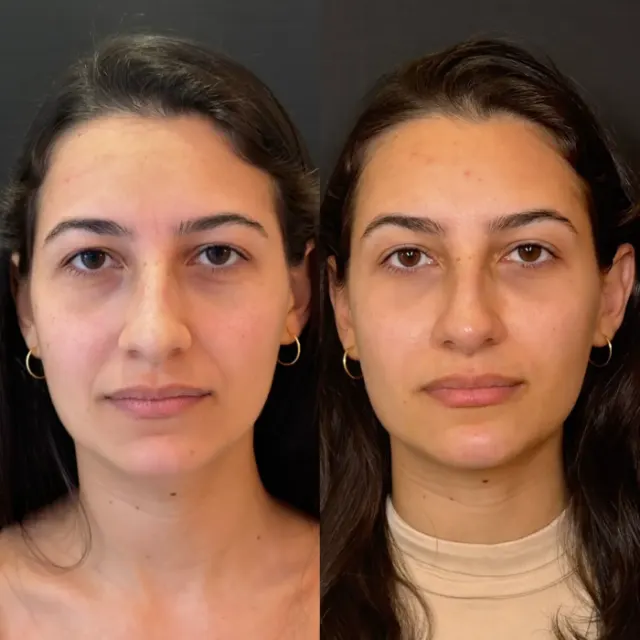 Antes e depois de procedimento de harmonização facial em Contagem, paciente 6