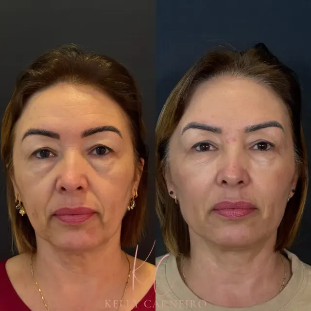 Antes e depois de procedimento de harmonização facial em Contagem, paciente 9