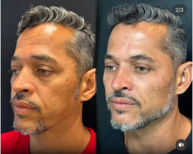 Antes e depois de procedimento de harmonização facial em Contagem, paciente 10