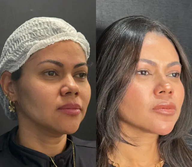 Antes e depois de procedimento de harmonização facial em Contagem, paciente 15