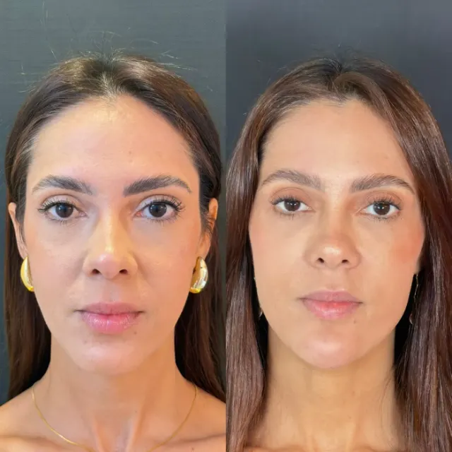 Antes e depois de procedimento de harmonização facial em Contagem, paciente 17