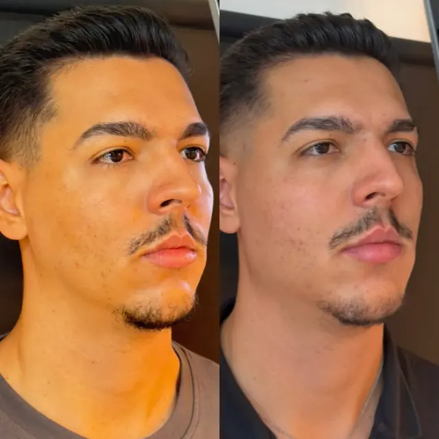 Antes e depois de procedimento de harmonização facial em Contagem, paciente 20
