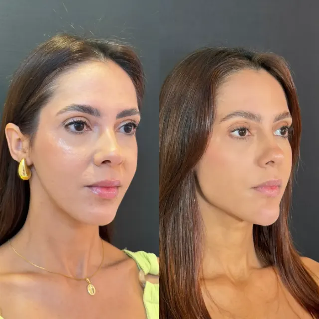 Antes e depois de procedimento de harmonização facial em Contagem, paciente 23